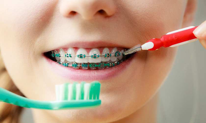 Chăm Sóc Răng Miệng Khi Niềng Răng