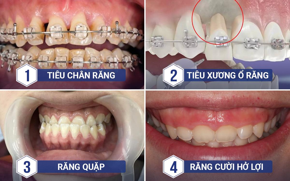 Rủi Ro và Biến Chứng Khi Niềng Răng