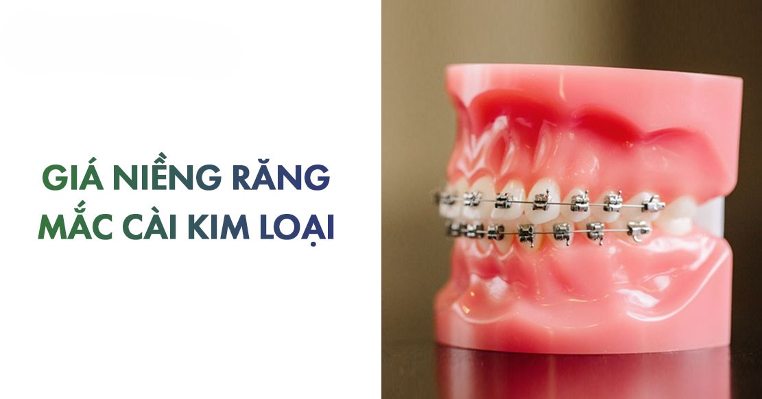 Niềng Răng Mắc Cài Kim Loại Tự Buộc/Tự Khoá - Giải Pháp Chỉnh Nha Hiện Đại 2025 8 Chi phí niềng răng mắc cài kim loại tự buộc năm 2025