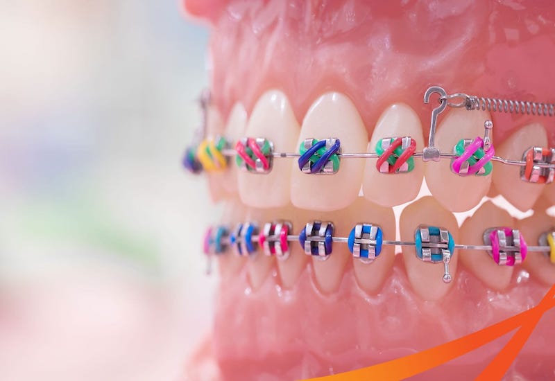 Định nghĩa và cấu tạo mắc cài kim loại