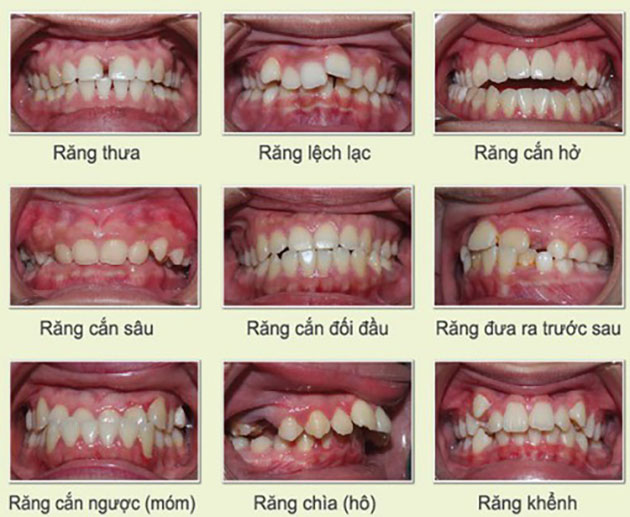 Tình Trạng Răng Miệng Ban Đầu