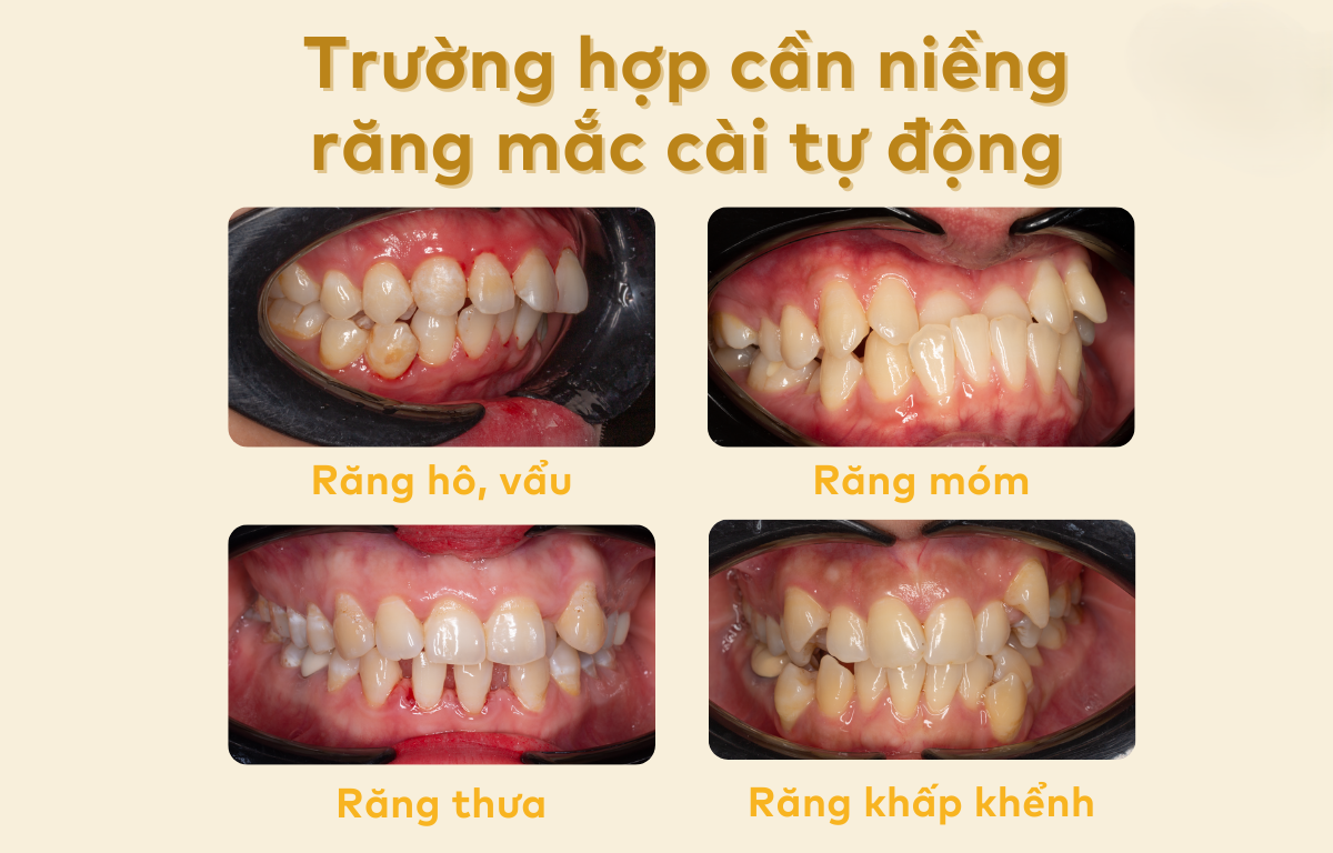 Niềng Răng Mắc Cài Kim Loại Tự Buộc/Tự Khoá - Giải Pháp Chỉnh Nha Hiện Đại 2025 9 Đối tượng phù hợp và chống chỉ định