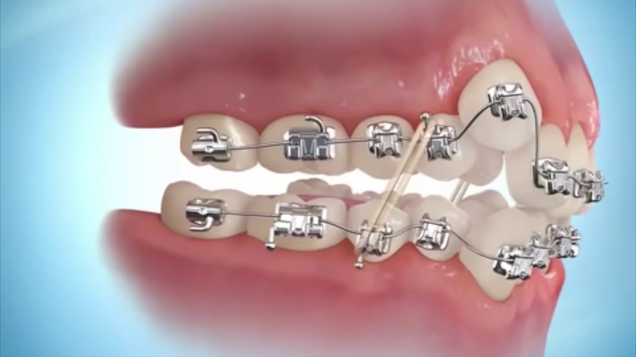 Bước 4 - Bắt đầu điều trị và thanh toán định kỳ