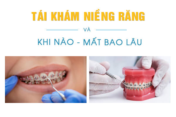 Niềng Răng Mắc Cài Kim Loại Tự Buộc/Tự Khoá - Giải Pháp Chỉnh Nha Hiện Đại 2025 7 Lịch trình tái khám và điều chỉnh tối ưu