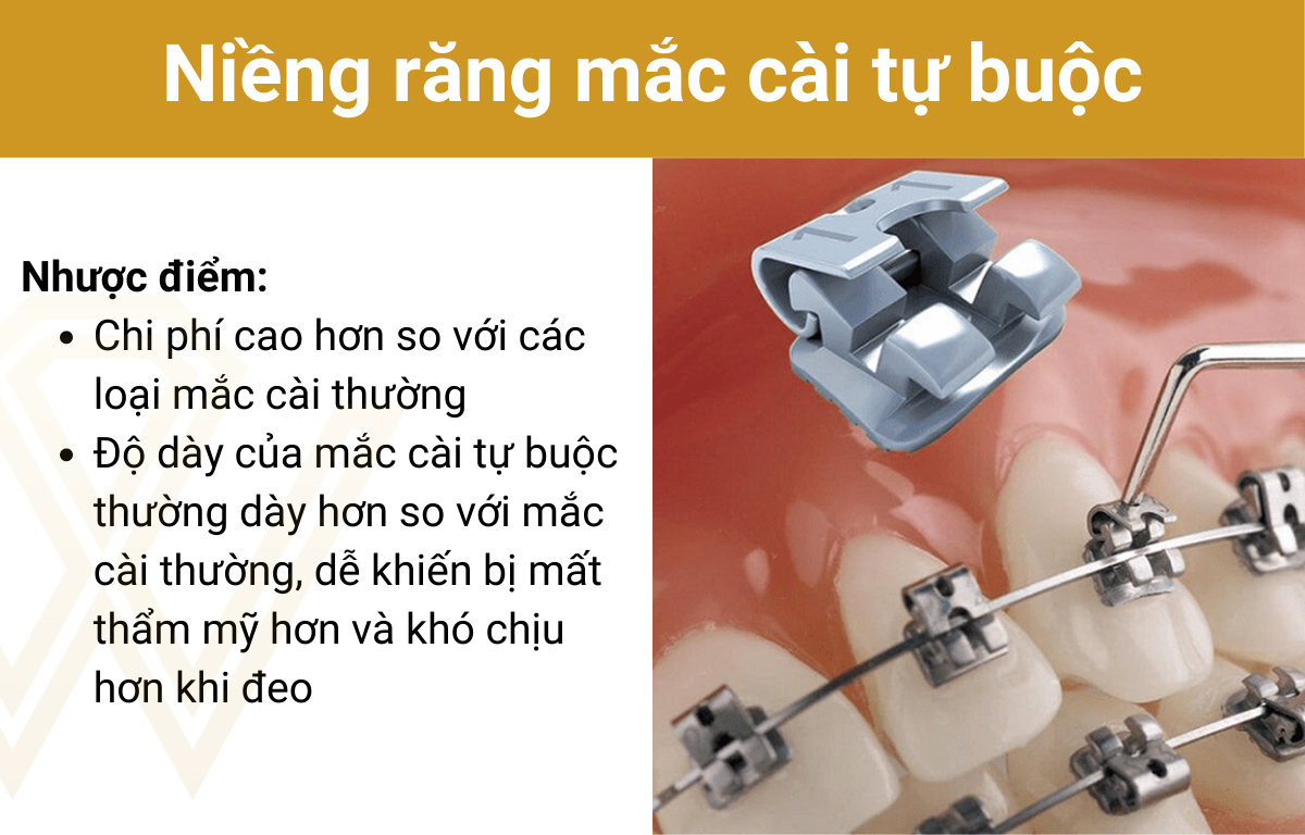 Niềng Răng Mắc Cài Kim Loại Tự Buộc/Tự Khoá - Giải Pháp Chỉnh Nha Hiện Đại 2025 12 Nhược điểm và cách khắc phục