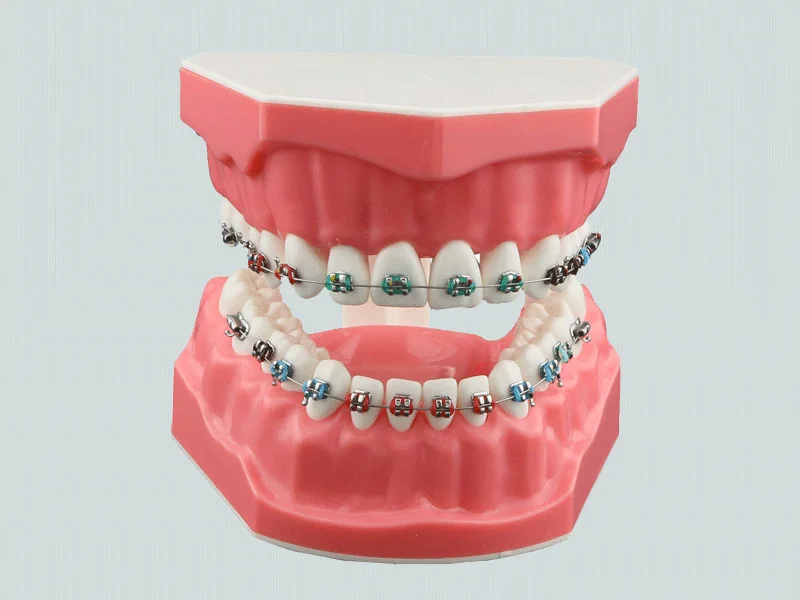 Niềng răng mắc cài kim loại thường
