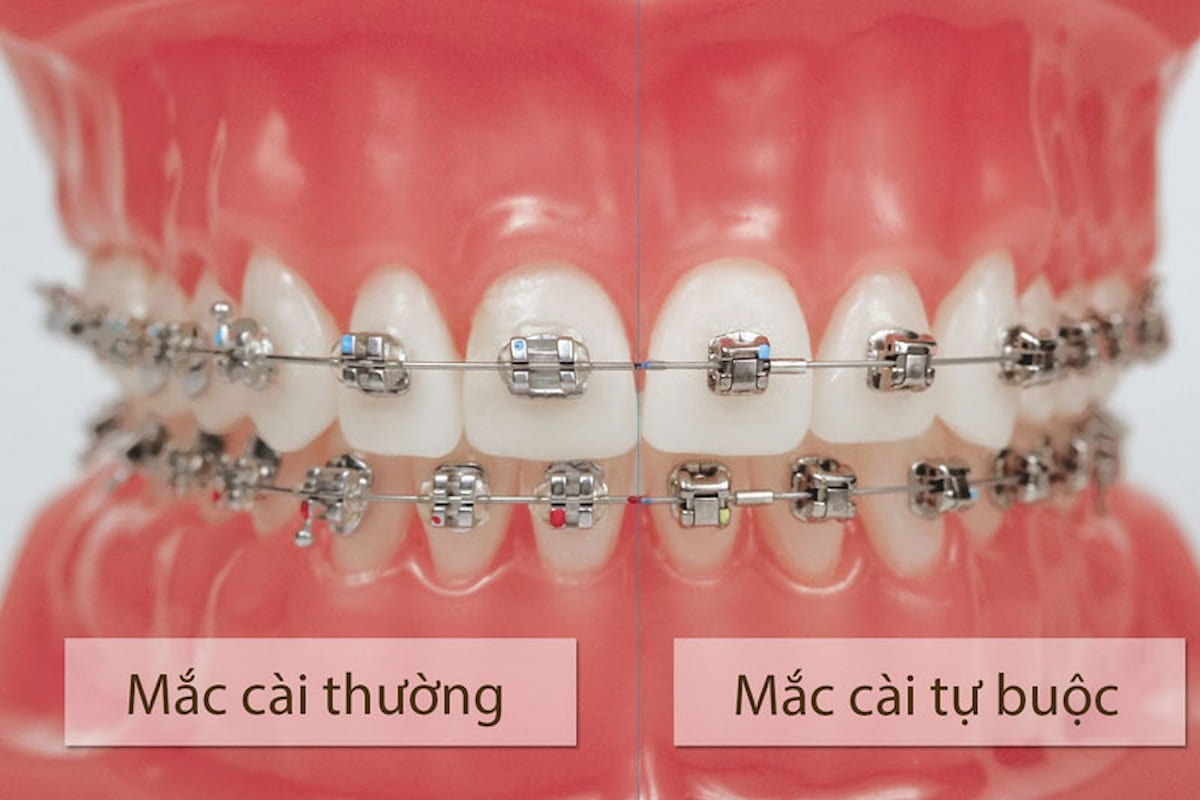Niềng Răng Mắc Cài Kim Loại Tự Buộc/Tự Khoá - Giải Pháp Chỉnh Nha Hiện Đại 2025 1 Niềng răng mắc cài kim loại tự buộc
