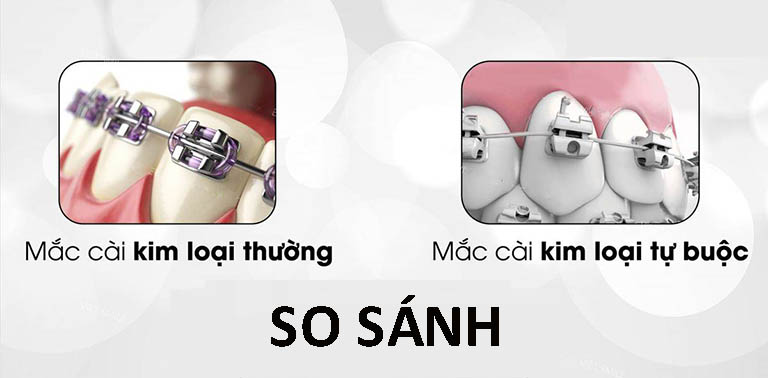 Niềng Răng Mắc Cài Kim Loại Tự Buộc/Tự Khoá - Giải Pháp Chỉnh Nha Hiện Đại 2025 4 So sánh toàn diện: Mắc cài tự buộc với mắc cài truyền thống