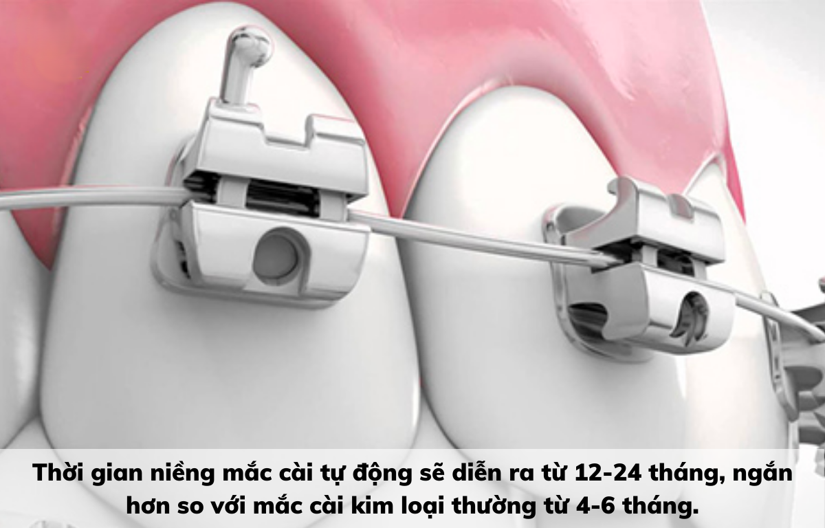 Niềng Răng Mắc Cài Kim Loại Tự Buộc/Tự Khoá - Giải Pháp Chỉnh Nha Hiện Đại 2025 5 Thời gian và quy trình điều trị chuẩn