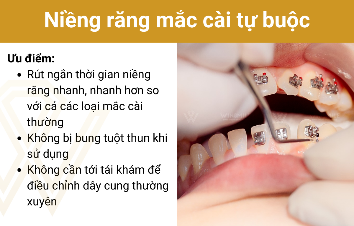 Niềng Răng Mắc Cài Kim Loại Tự Buộc/Tự Khoá - Giải Pháp Chỉnh Nha Hiện Đại 2025 3 Ưu điểm vượt trội của mắc cài kim loại tự buộc