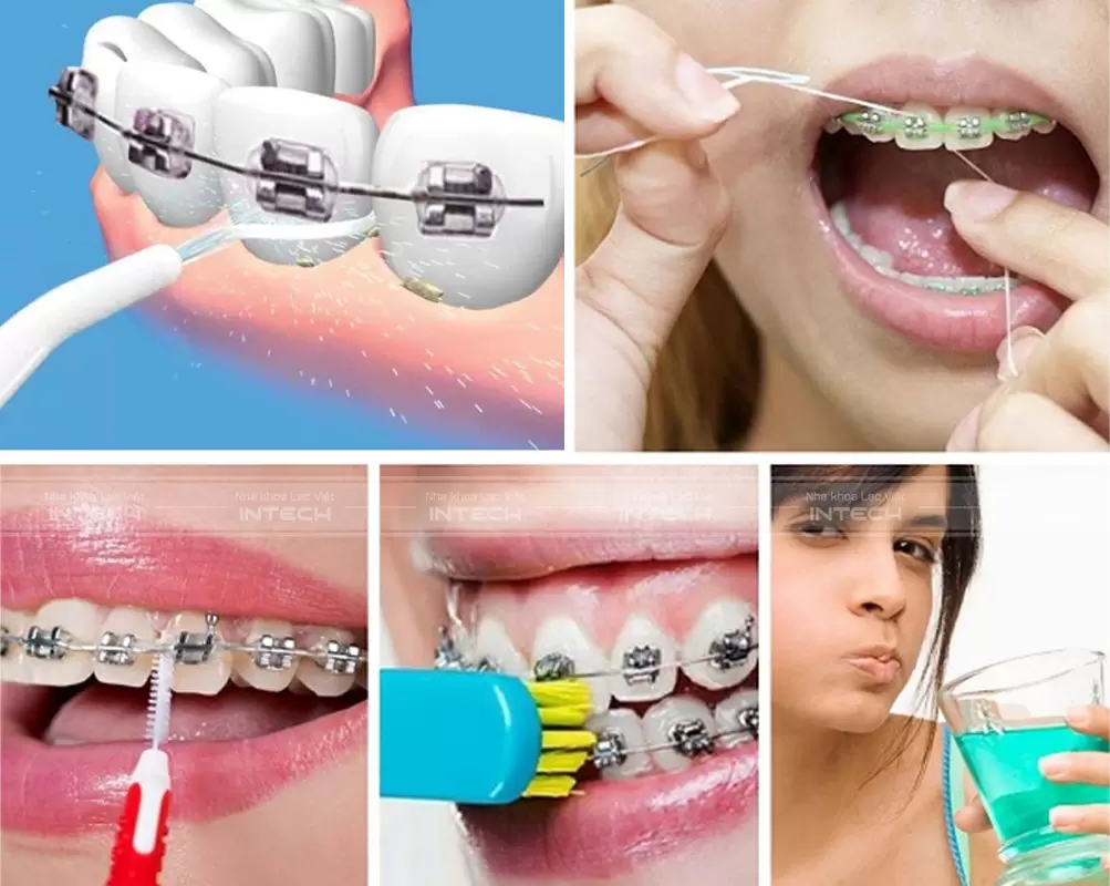 Vệ Sinh Răng Miệng Đúng Cách Hàng Ngày