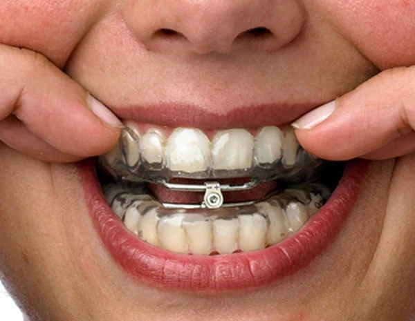 Bảo vệ mắc cài khi tham gia hoạt động thể thao và giải trí