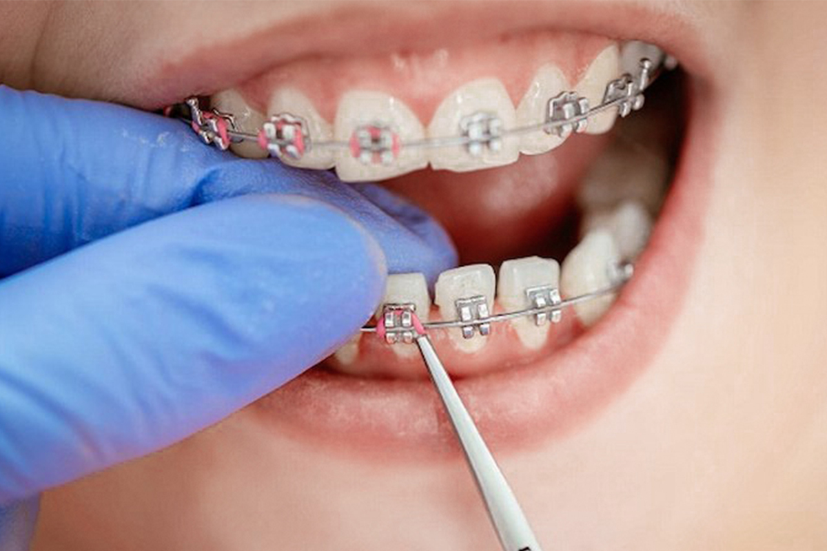 Gãy Hoặc Lỏng Mắc Cài