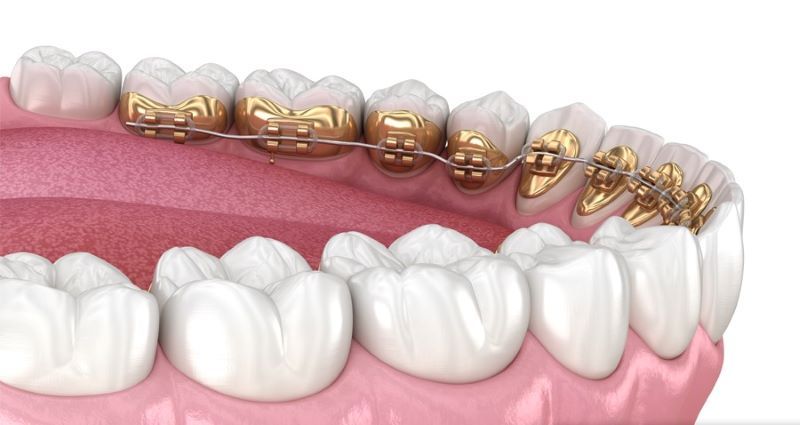 Mắc cài kim loại mặt trong thẩm mỹ