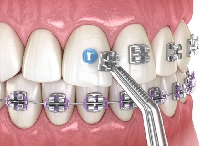 Niềng răng mắc cài kim loại có đau không