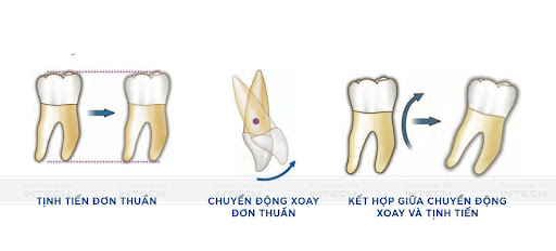 Quá trình di chuyển răng theo giai đoạn