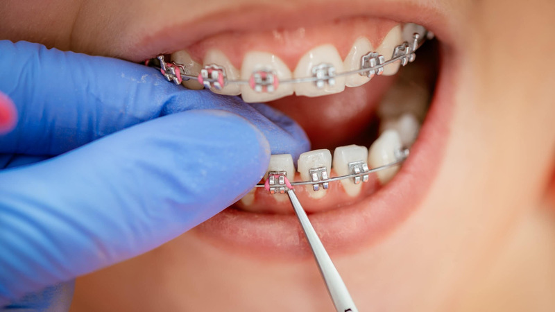 Quá trình điều chỉnh và mức độ đau dự kiến