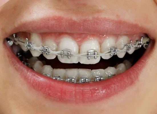 Niềng răng mắc cài kim loại thường giá bao nhiêu