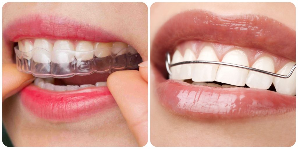 Tháo niềng và gắn hàm duy trì kết quả