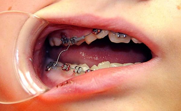 Tổn thương niêm mạc miệng nghiêm trọng