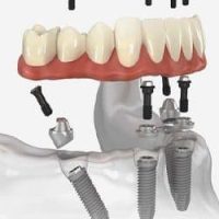 Bảng Giá Trồng Răng Implant Trọn Gói Tại Guva Dental 2024 7 Vật liệu trụ Implant