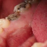 Bảng Giá Trồng Răng Implant Trọn Gói Tại Guva Dental 2024 8 Tình trạng răng miệng