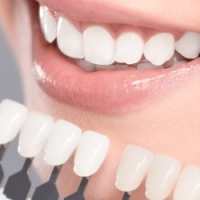 Số lượng răng cần thẩm mỹ